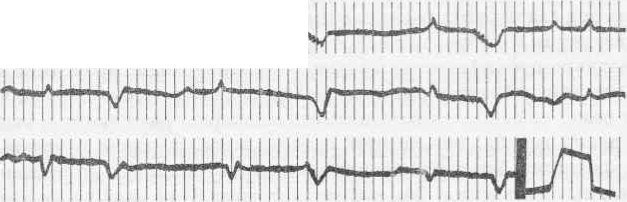 Рис. 102 Электрокардиограмма лошади при миокардите
