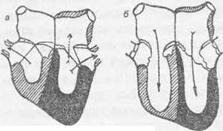 Рис. 106 Схема положения клапанов и места возникновения шума при недостаточности левого атриовентрикулярного клапана а — стадия систолы; левый атриовентрикулярный клапан закрыт неполностью; б стадия диастолы; изменений в токе крови нет.