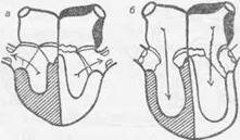 Стеноз (сужение) левого атриовентрикулярного отверстия (рис. 107).