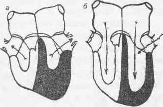 Рис. 108 Схема сердца при недостаточности клапанов аорты а — систола; б — диастола.