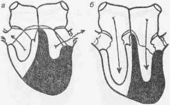 Рис. 109 Схема сердца при сужении аортального отверстия а — систола; б — диастола.