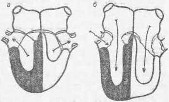 Рис. 111 Схема сердца при недостаточности клапанов легочной артерии а — систола; б — диастола