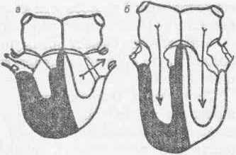 Рис. 112 Схема сердца при сужении отверстия легочной артерии а — систола; б — диастола