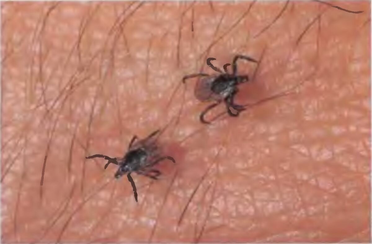 Клещи на коже человека