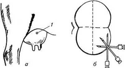 Рис. 18. Схема парансфральной (поясничной) новокаиновой блокады лошади по И. Я. Тихонину: б — вид справа; в — вид слева; / — левая почка; 2 — длиннейшая мышца спины; 3 — положение иглы при блокаде; 4 — подвздошно-реберная мышца; 5—правая почка